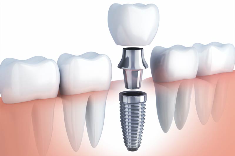 Implants Dentist in Gig Harbor