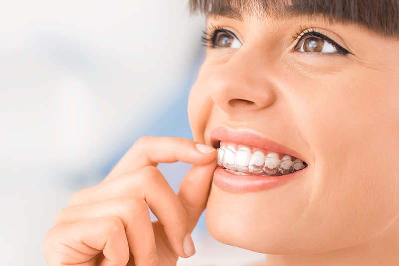 Clear Aligners in Gig Harbor
