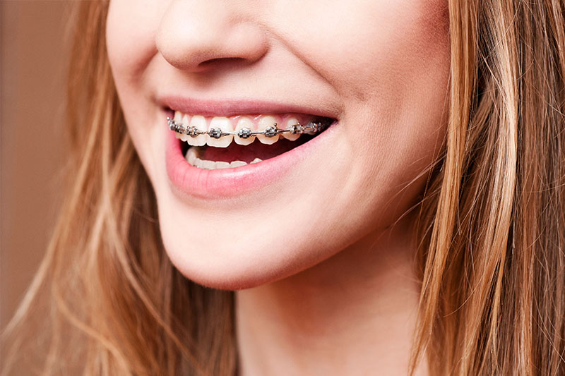 Orthodontics in Gig Harbor