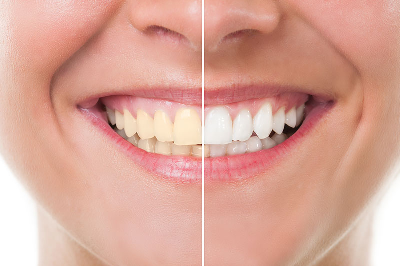 Professional Teeth Whitening in Gig Harbor